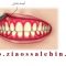 روش درمان آبسه دندان و روش های پیشگیری آن